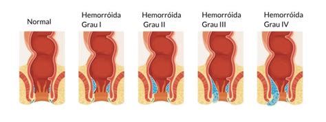 hemorroida externa grau 1